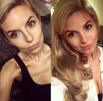 Gb, gli scatti prima e dopo l'anoressia: su Instagram la vittoria sulla malattia