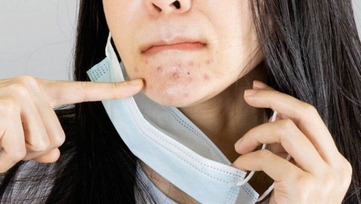  Gli aiuti green per intervenire sull’acne da mascherina