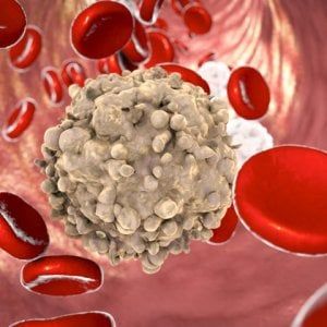 Leucemia linfatica cronica: migliora il tempo libero da progressione
