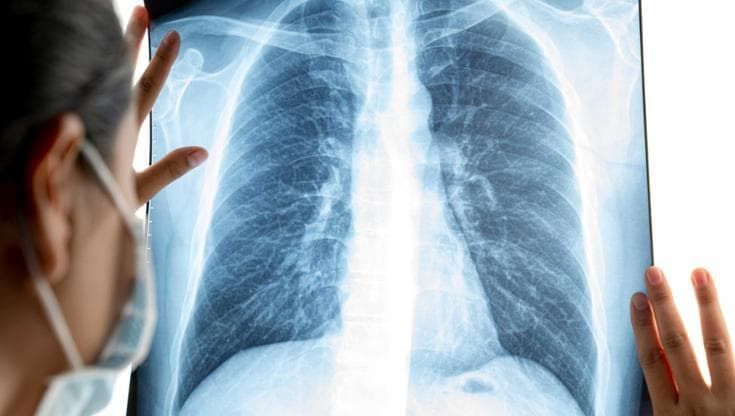 Ipertensione arteriosa polmonare, rimborsabile un nuovo farmaco biologico