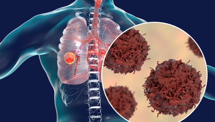 Tumore al polmone con mutazione HER2: nuova possibile opzione terapeutica in prima linea