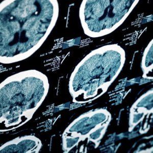 Ictus,"Stimolazione cervello ridà movimento al braccio colpito"