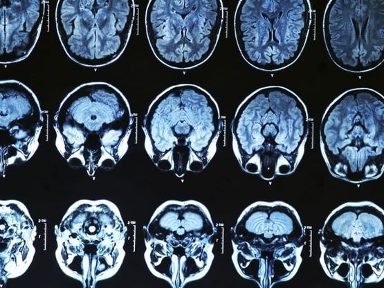 Identificata una proteina nel sangue che potrebbe predire il rischio di Alzheimer