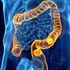 Tumore al colon-retto, quanto sono efficaci gli screening?