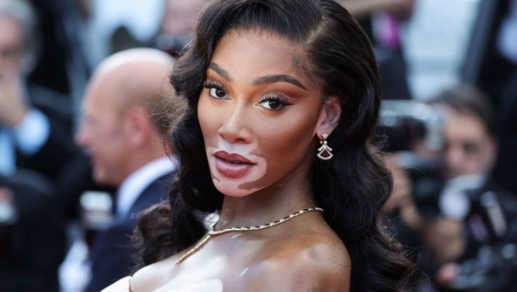 Chi è Winnie Harlow, la prima modella con la vitiligine