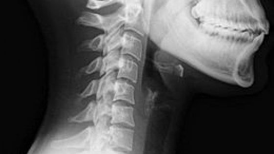 Ingoia un amo 'dimenticato' da cuoco all'interno di una polpetta di polpo: donna operata dopo un pranzo a Porto Cesareo 