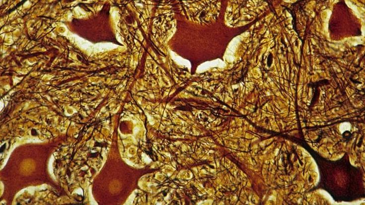 Sclerosi multipla: così muoiono i neuroni nella corteccia cerebrale