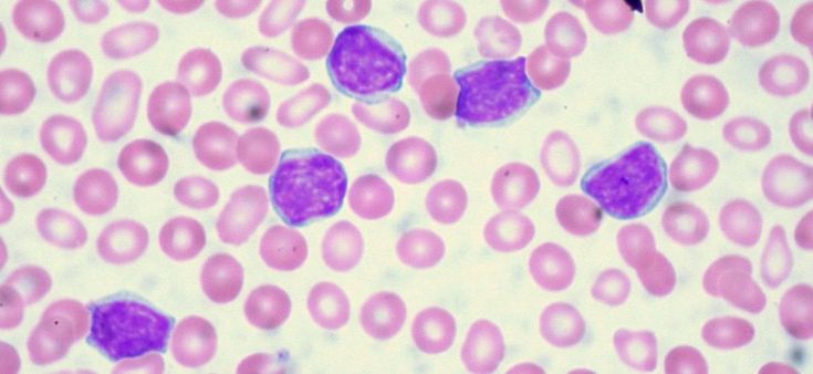CAR-T, strada aperta anche per la leucemia linfatica cronica