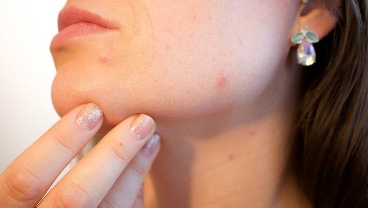 Contro l'acne quel che serve è (anche) un probiotico 