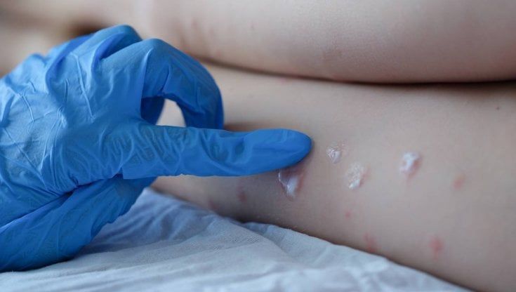 Vaiolo delle scimmie, l'Infettivologa del Policlinico di Bari: "Ecco come si trasmette, massima attenzione ma abbiamo le cure"