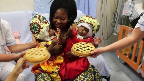 Due gemelline siamesi unite dalla testa, separate al Bambino Gesù