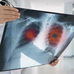 Tumore del polmone: nuova terapia mirata raddoppia sopravvivenza nei pazienti Alk positivi