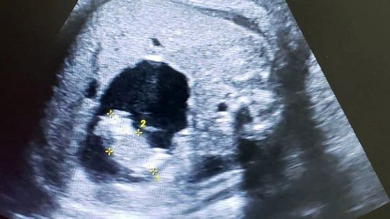 Una gemella dentro una gemella, nascita straordinaria in Colombia