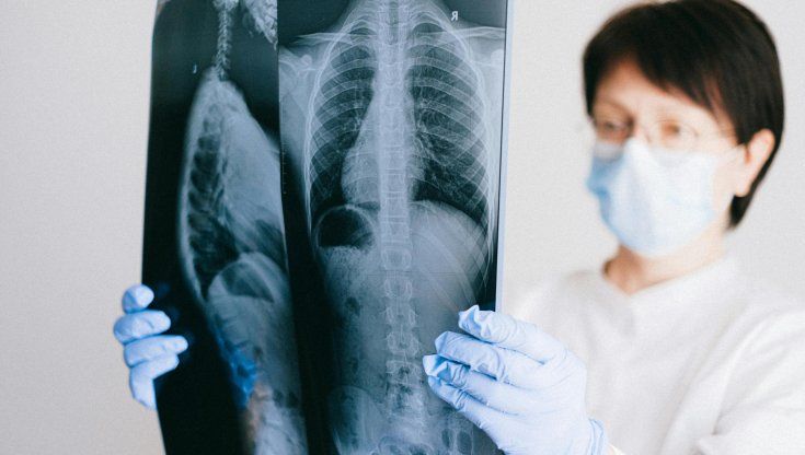 Tumore del polmone: Europa approva immunoterapico prima e dopo la chirurgia