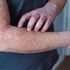 Lupus, al via il primo registro italiano: migliorerà la diagnosi (che arriva dopo anni)