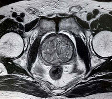 Prostatite, tre domande per scoprirla subito. Ma per gli uomini è ancora un tabù