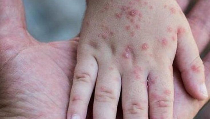 Vaiolo delle scimmie, il medico che ha scoperto il primo caso in Puglia: "Ho visto sintomi diversi dalle altre malattie note. Forse contratto in Africa"