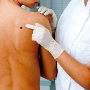 ‘Riscaldare’ il tumore per rendere più efficace l’immuno-oncologia