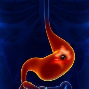Tumore allo stomaco, 3.200 pazienti senza rimborso per gli integratori