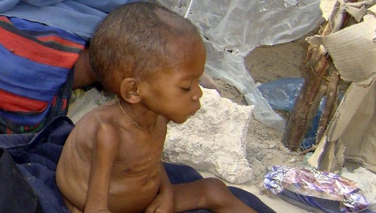 Etiopia, bambini malnutriti, fragili e adesso esposti anche al rischio di ammalarsi di colera o di morbillo