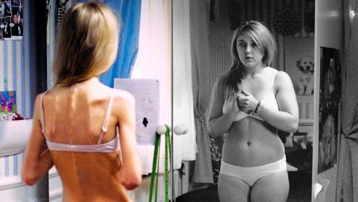 Anoressia e bulimia in aumento col lockdown, allarme per i bambini dagli 8 anni in su