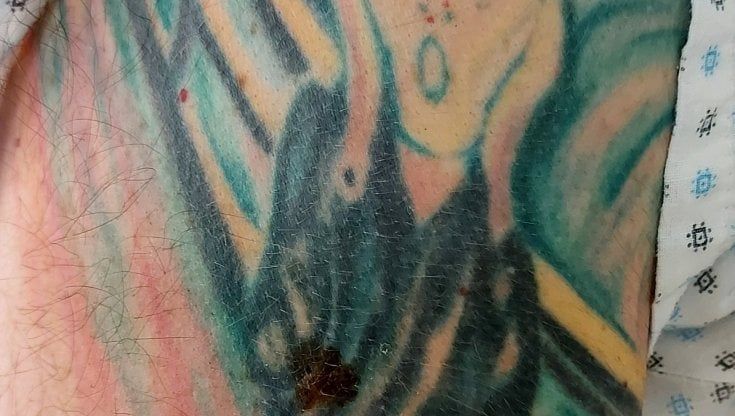 Nei e tatuaggi: i rischi nella diagnosi del melanoma
