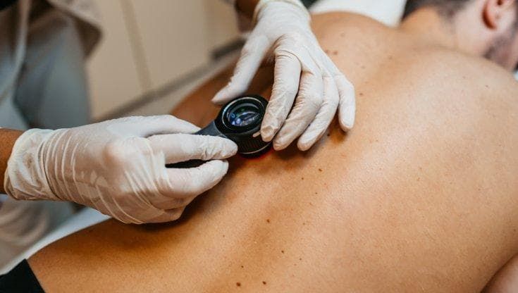 Melanoma: l’immunoterapia prima dell’intervento funziona