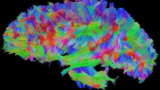 ''Switch'' cerebrale per salvare il cervello: è il primo caso al mondo