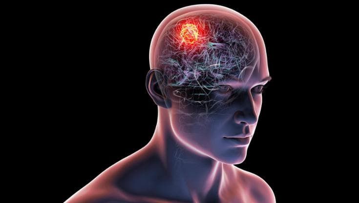 Glioblastoma, risultati promettenti per un vaccino personalizzato