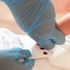 Diabete di tipo 1, al via anche in Italia un programma di screening neonatale