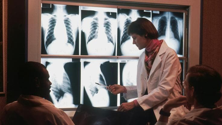 Tumore al polmone, nel sangue la ‘firma’ che prevede il rischio 5 anni prima della diagnosi