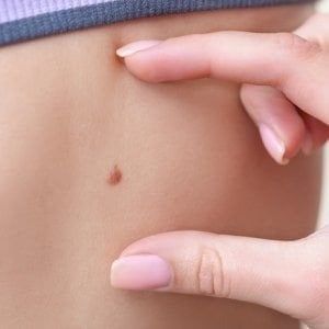 Melanoma, approvata in Italia una nuova terapia mirata