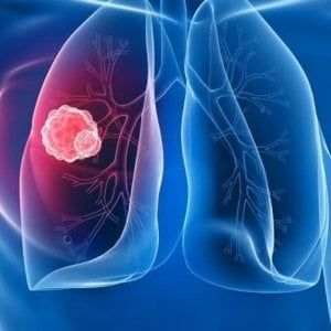 Mesotelioma: l’immunoterapia diventa ‘su misura’ per combattere il cancro