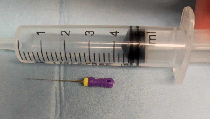 Inala un ago dal dentista durante la devitalizzazione: paziente di 45 anni salvata con un intervento d'urgenza a Bari