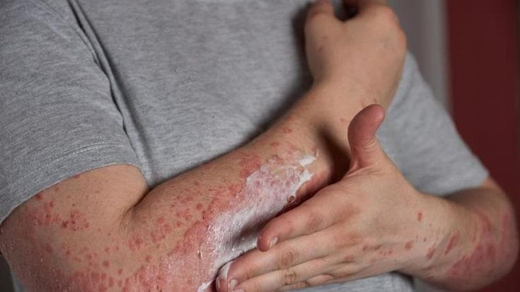 Emergenza scabbia: resistenza ai farmaci, cure costose e inefficaci, tutte le criticità in Italia