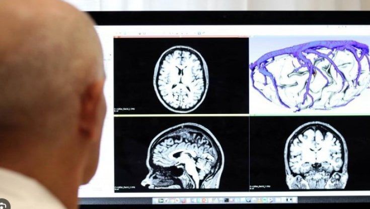 Parkinson, svelato il meccanismo che fa esplodere la malattia