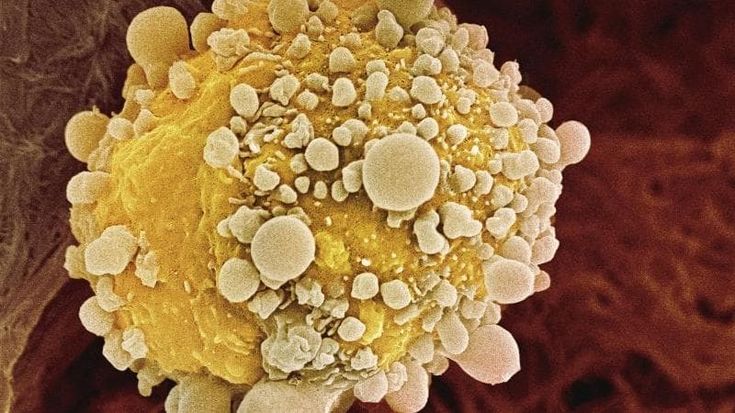 Tumore del pancreas, ritirato lo studio che aveva illuso il mondo. “Autori in conflitto d’interesse”