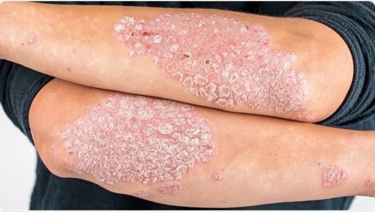 Psoriasi: disagi oltre la pelle per 1 milone e mezzo di pazienti