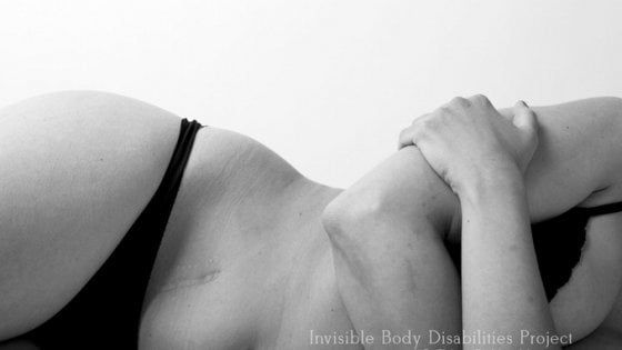 Senza vergogna, davanti all'obiettivo per mostrare le malattie invisibili