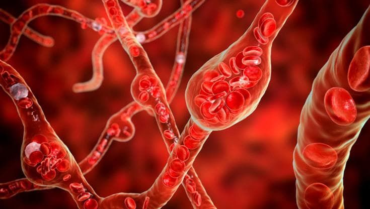 Aneurismi, svelato il meccanismo che rompe le arterie