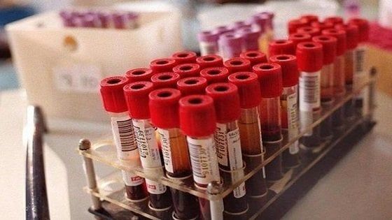 Sla: nuovo test del sangue per la diagnosi precoce