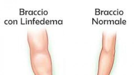 Linfedema, una malattia ancora sconosciuta