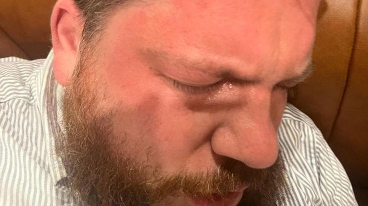 Attentato in Lituania, l’ex vice di Navalny colpito a martellate