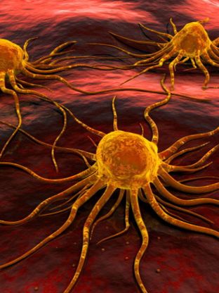 Cancro al seno, italiani scoprono proteina che favorisce metastasi