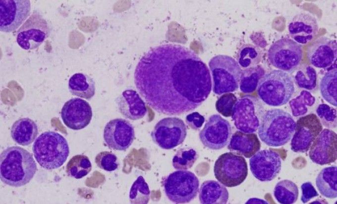 Leucemia, una bimba di 9 anni guarisce con ogm anticancro