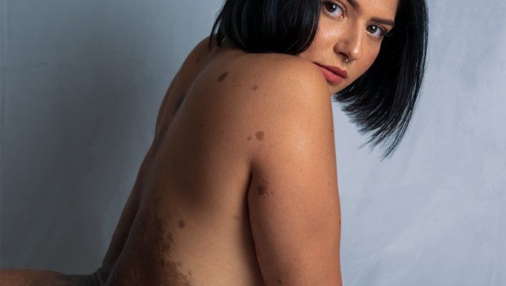  Pia Salatino, la modella che convive con un nevo melanocitico gigante: "Non sarà una macchia a farmi sentire meno bella"