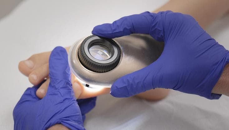 Melanoma nei bambini, il decalogo dei falsi miti