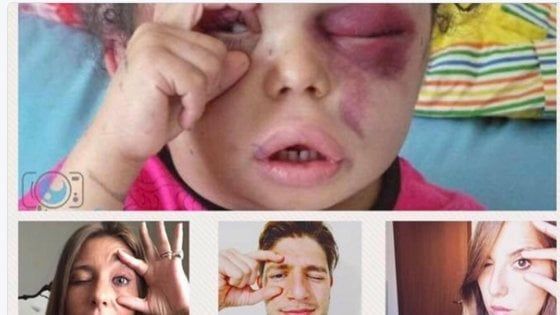 "Occhi aperti" sullo Yemen, il gesto di una bimba diventa il simbolo del conflitto