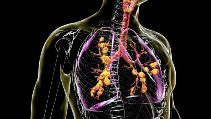 Fibrosi cistica, una “correzione” genetica offre una speranza ai pazienti senza cure