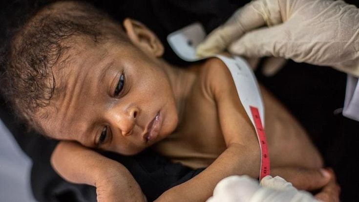 Yemen, fame e malnutrizione sono endemiche per i bambini del Paese, mentre la guerra si intensifica